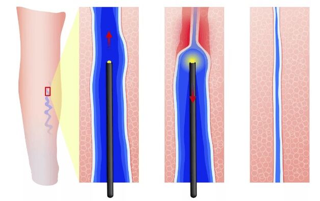 Electrocoagulación endovasal