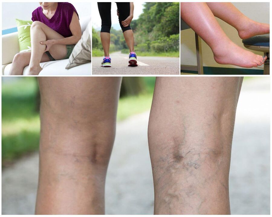 Comienzo de varicosis