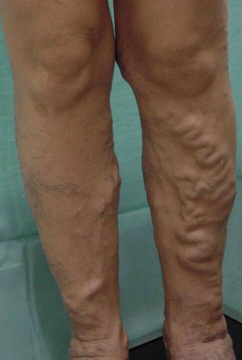 Venas varicosas en las piernas