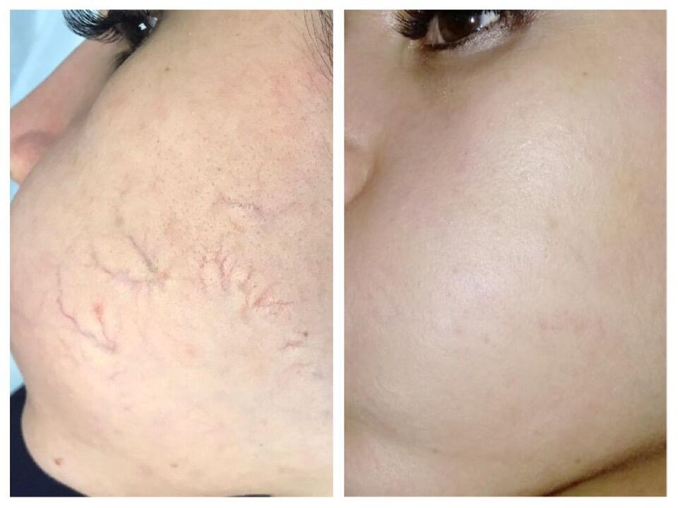 varices