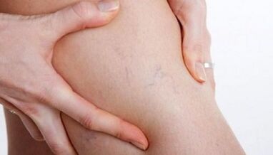 Cómo se manifiestan las venas varicosas en las piernas