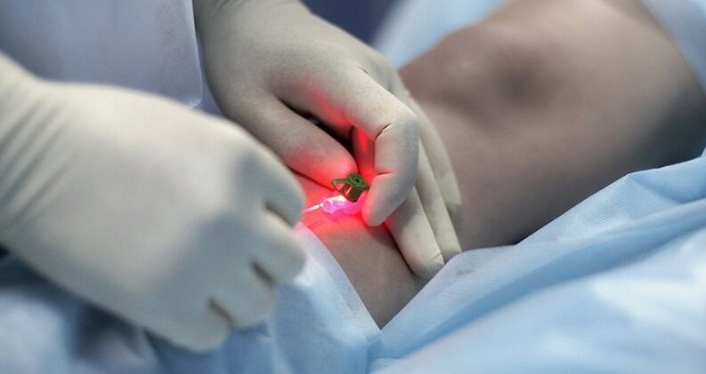 Tratamiento quirúrgico de las varices.